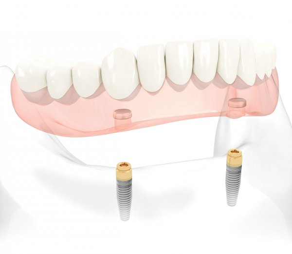 Totale onderprothese op implantaten